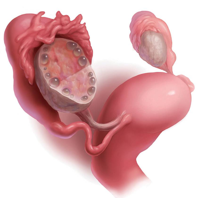 PCOS